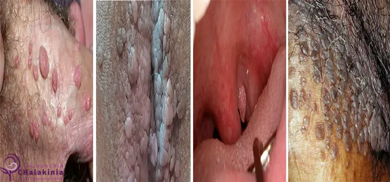 انواع زگیل‌های تناسلی