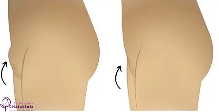 جراحی مونس پلاستی