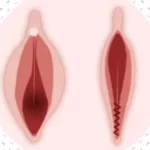 عمل پرینورافی
