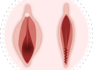 عمل پرینورافی