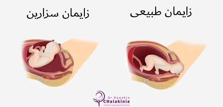 عمل سزارین بهتر است یا زایمان طبیعی