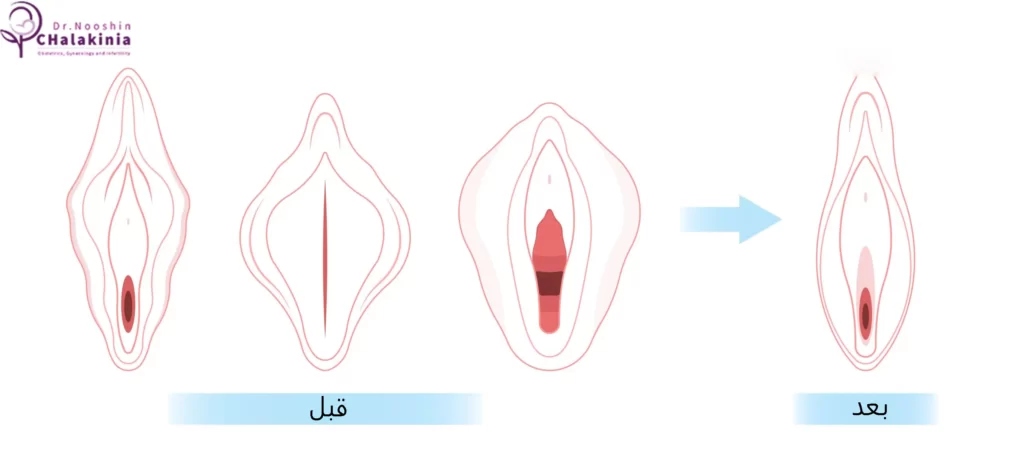  مراحل جراحی لابیاپلاستی با لیزر