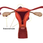 آندومتریوز