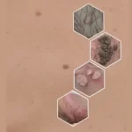 عوامل خطر زگیل خطر تناسلی