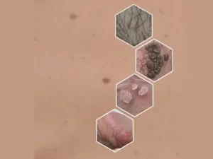 عوامل خطر زگیل خطر تناسلی