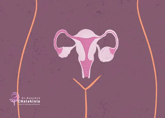 آزمایش و تشخیص تنبلی تخمدان