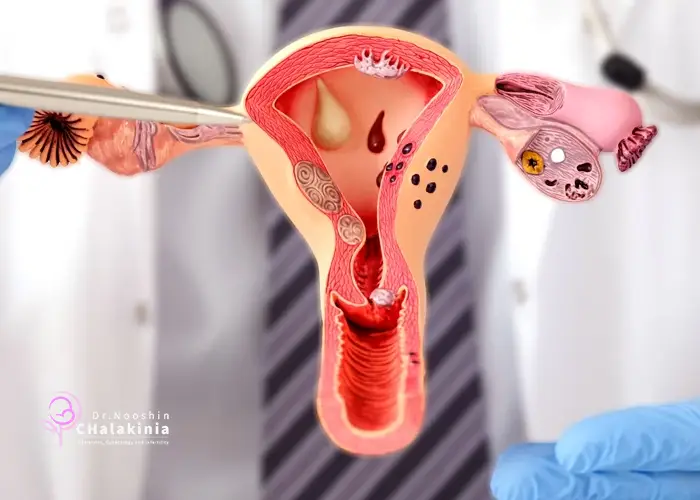 علائم تنبلی تخمدان
